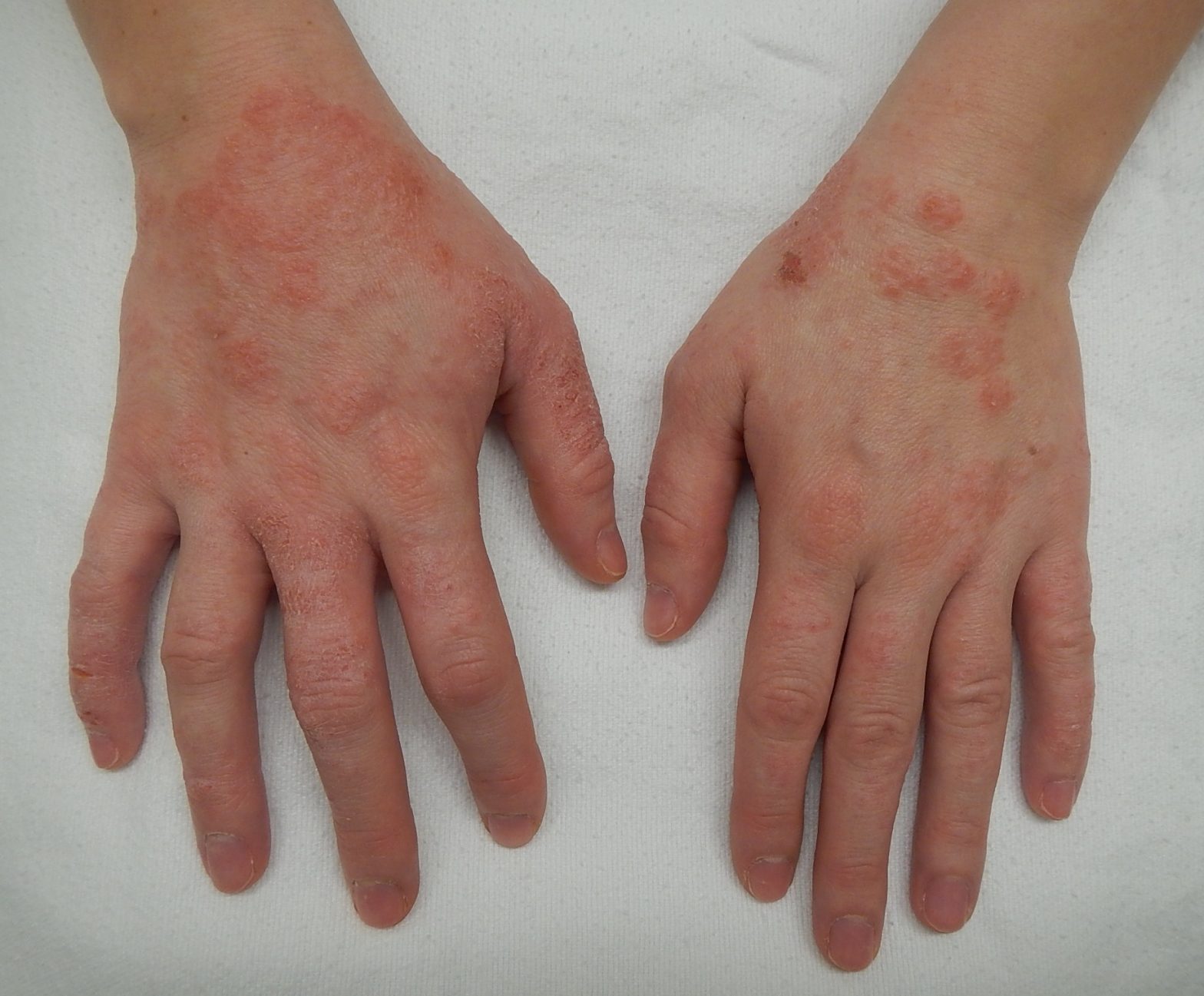 Eczema Symptoms, Causes, Prevention & Treatment Options