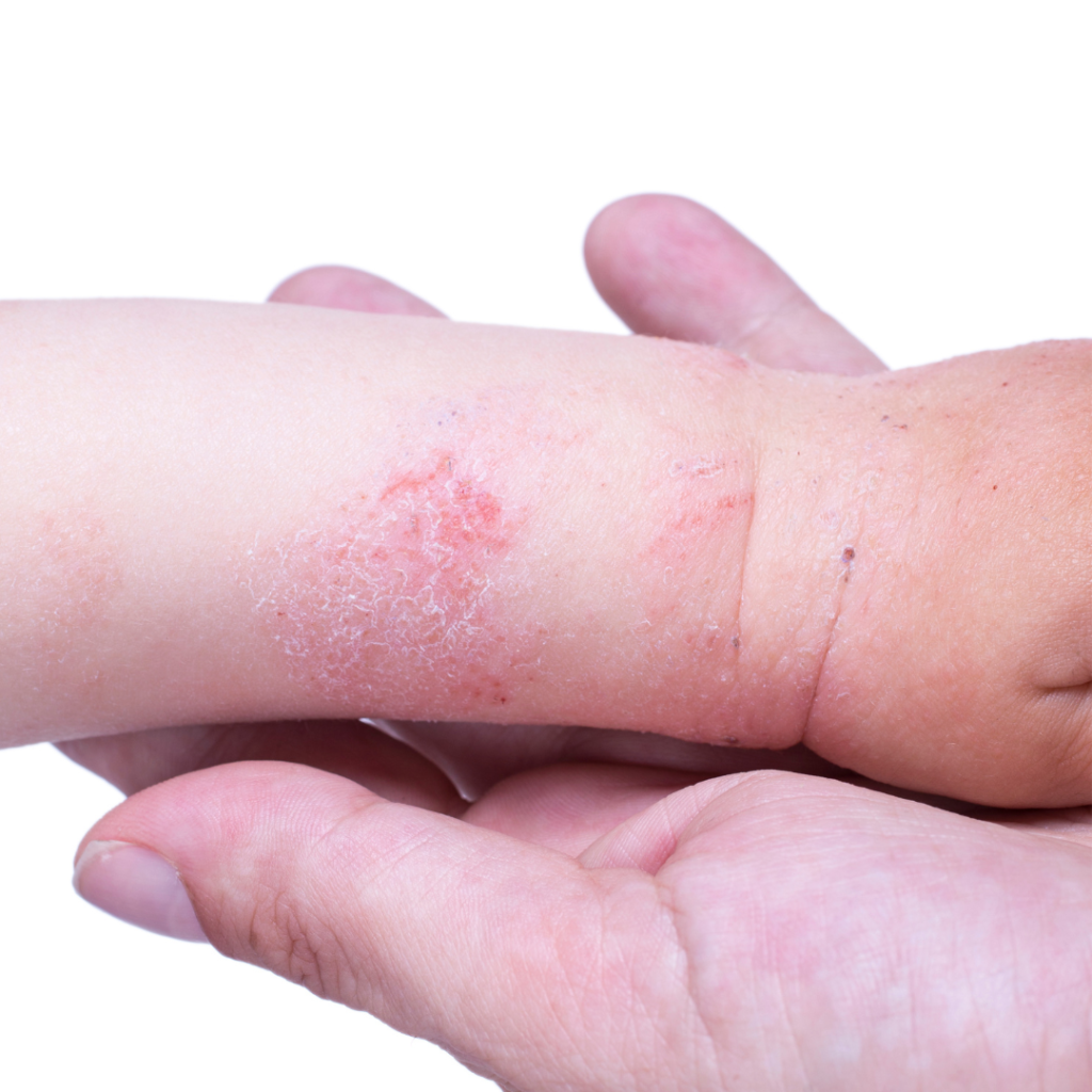 allergy eczema new research