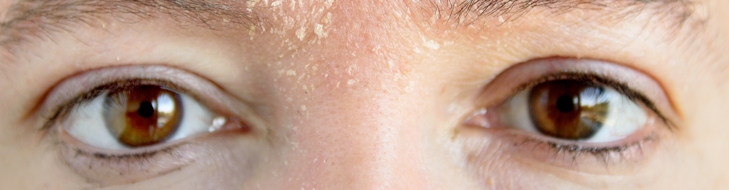 Eczema Around Eyes