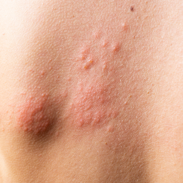 hives-vs-eczema