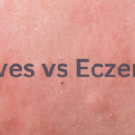 Hives vs Eczema