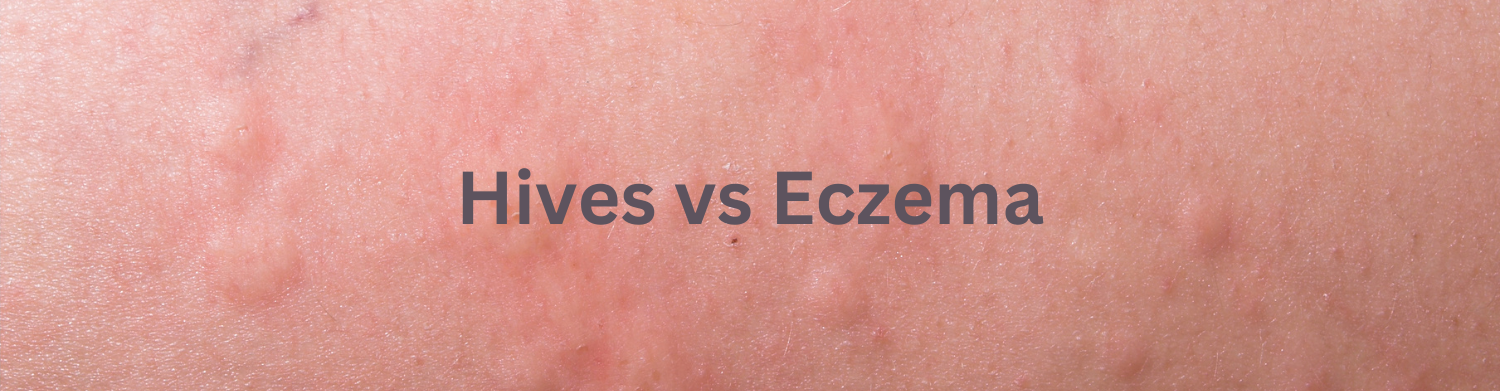 Hives Vs Eczema