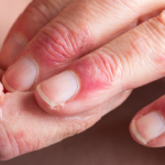 The Impact of Atopic Dermatitis on the Hands: Symptoms and Treatment Options
