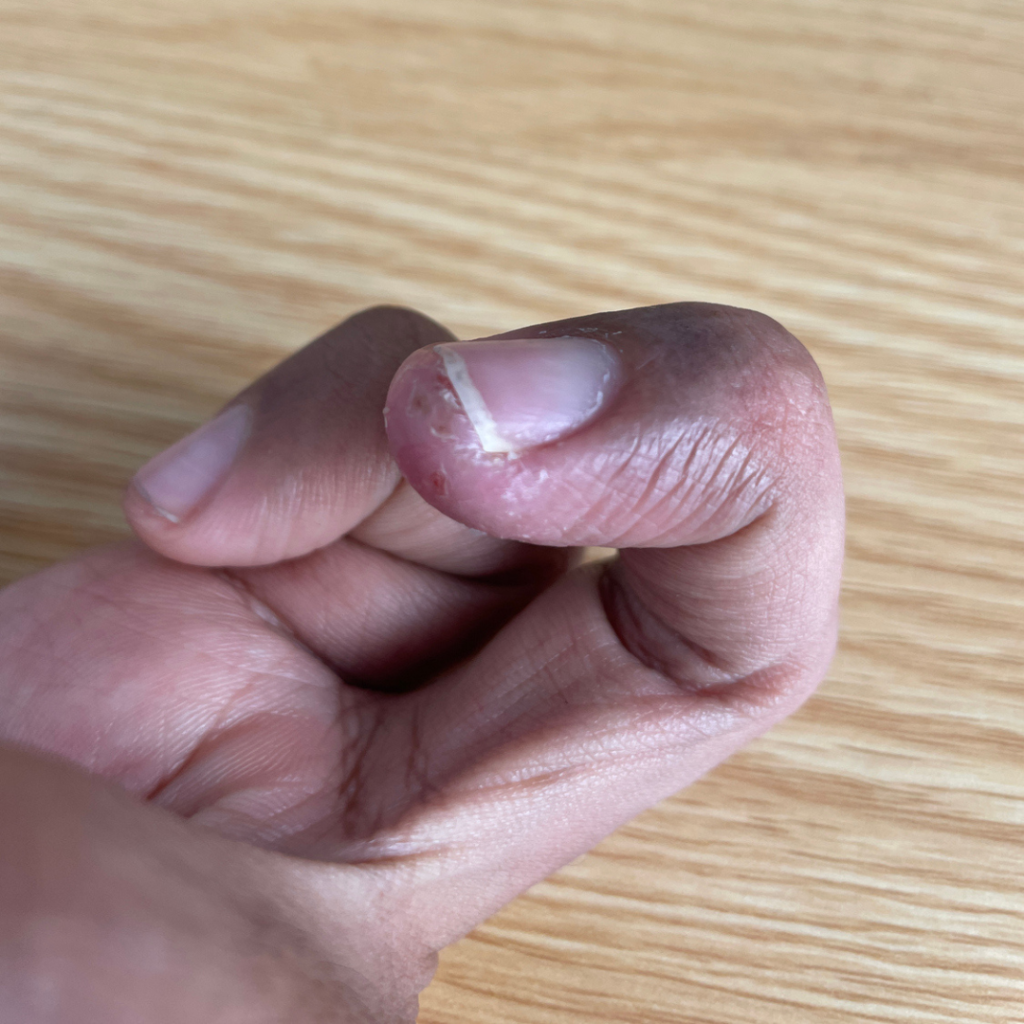 Eczema on fingertips