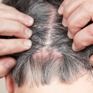 Scalp Eczema Vs Psoriasis Back of Head