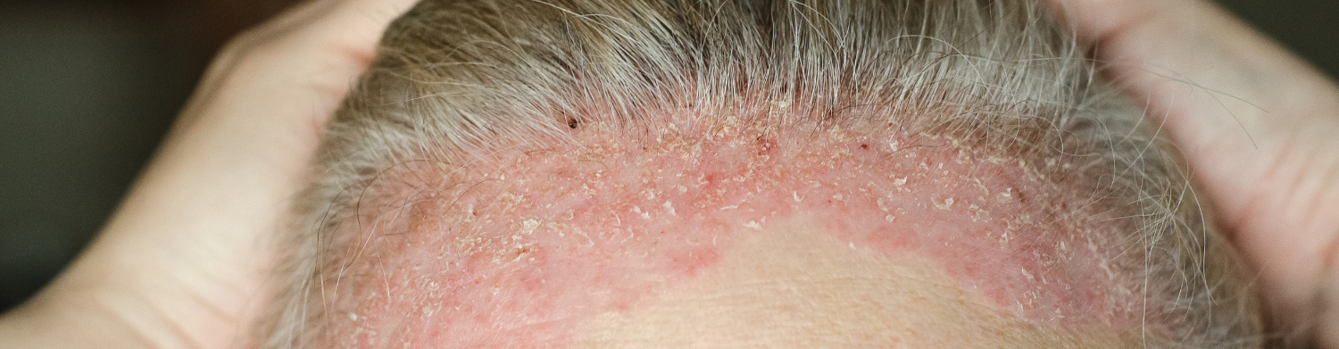 Scalp Eczema Vs Psoriasis Hairline