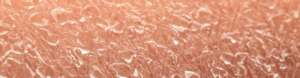 Close-up macro view of extremely dry, flaking skin with rough, cracked texture characteristic of atopic eczema, showing lifted skin flakes across a pink-toned surface