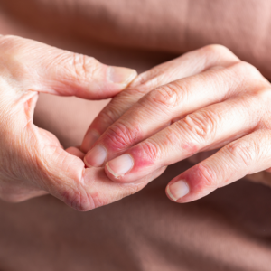 Close-up of hands with dry, cracked, and inflamed skin on the fingers, showing symptoms linked to atopic dermatitis causes