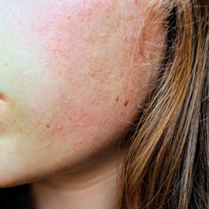 Close-up of a person's cheek showing widespread facial eczema, with red, inflamed, and slightly rough skin texture visible near the hairline