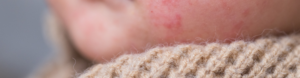 Close-up of a child's chin showing red, irritated patches of eczema on the skin, with a beige knit sweater collar visible in the foreground