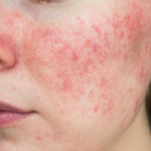 Reddened cheek with small bumps and visible flushing, a hallmark sign in eczema vs rosacea