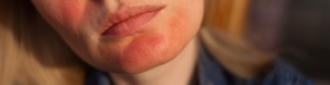 Close-up of red, irritated skin around the mouth and chin in an eczema vs rosacea comparison