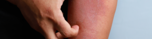 Atopic dermatitis Canada: hand scratching a red, flaky, inflamed patch of skin on the forearm