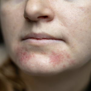 Close-up of a red, scaly rash around the mouth and chin, a pattern often discussed when comparing atopic dermatitis and allergic contact dermatitis