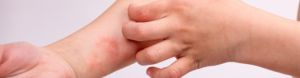 Person scratching an itchy red rash on the wrist, a symptom common to both atopic dermatitis and allergic contact dermatitis
