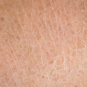 Close-up of dry, cracked skin showing the surface barrier where the skin microbiome connection begins