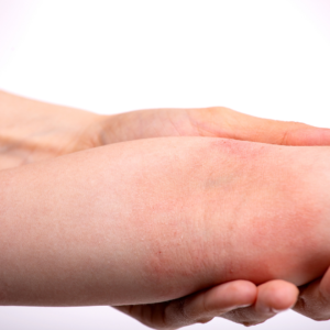Person holding their forearm where atopic dermatitis has left red, irritated skin, a common reason people try a probiotic for atopic dermatitis