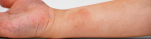 Red, flaky atopic dermatitis patch on a forearm, the kind of eczema flare a probiotic for atopic dermatitis may help calm