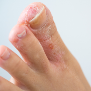 Close-up of red, peeling skin on the big toe and between the toes, a sign of eczema or athlete's foot