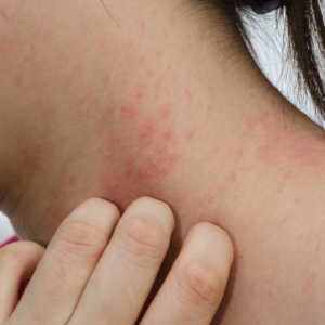 Person scratching a red eczema rash on her neck, often linked to skin microbiome imbalance